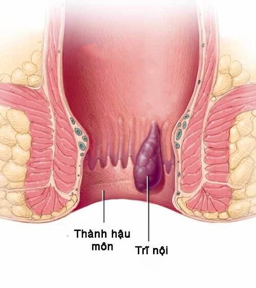 Hình ảnh trĩ nội